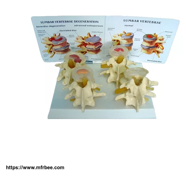 4 Pcs Vertebrae Nomorl Diseaser Composition Model