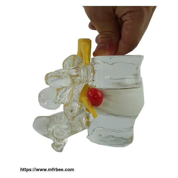 Human Crystal Vertebral Simulator Lumbar Disc Herniation Model